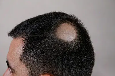 斑秃